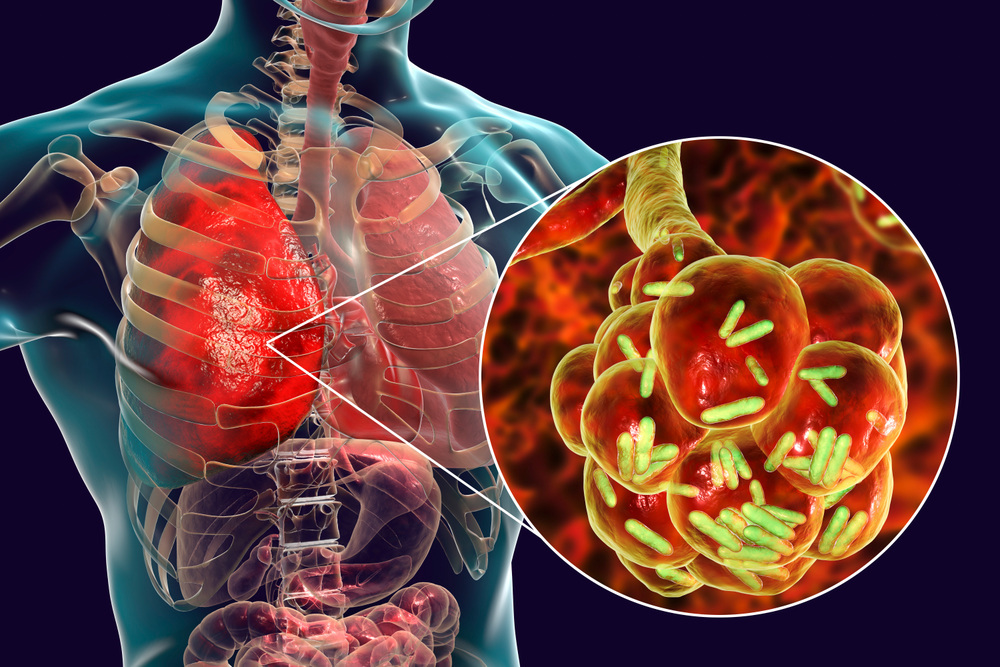 人体肺部脏器器官组织细菌感染透视剖面图